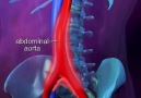 Abdominal Aort Anevrizması - Abdominal Aortic Aneurysm