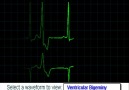 EKG ritimleri - Medikal Paylaşım [HQ]