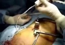 Kalp Pili Ameliyatı