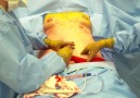 Abdominoplasty