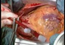 Açık kalp ameliyatı - www.teknovid.com