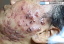 Acne Treatment TV - My God! Acne has ruined his face Facebook