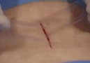 Adis a los puntos de sutura! Menudo invento