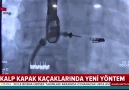 ahaber - Kalp kapak kaçaklarında yeni yöntem