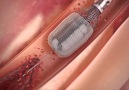 A Machine That Can Remove Cholesterol Plaques