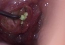 Apparently tonsil stones are a thing and its terrifying