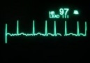 Atrial Fibrilasyon (AF)