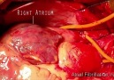 Atrial Fibrillaton Vs Atrial Flutter