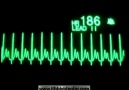 Atriyal Taşikardi Nedir? ( EKG RİTİMLERİ)