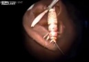 Big Bug removed from Ear