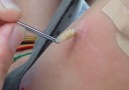 Botfly Maggot Removal