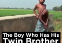 Boy Has Brother Growing Inside Of Him
