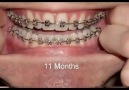 Braces - Photo taken every day - Before and After Transformation
