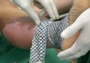 Brazilian doctors are using fish skin to treat burn victims heres why.