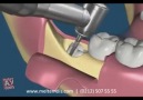 Çıkmayan 20 lik dişlere cerrahi müdahale - www.teknovid.com