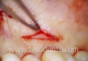 Connective tissue graft - Single-incision technique