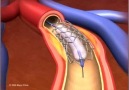 Coronary Angioplasty and Stenting