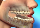 Corrective Jaw Surgery