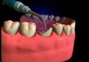 crown and core buildup