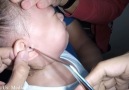 Crying Baby Girl&Stuffed Cotton Balls Removed from Her Ears