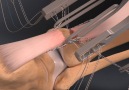 3D animation shows the repairing of an Achilles tendon via Arthrex