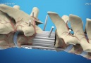 3D bone printing for the spine