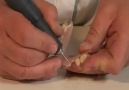 Deflex Kroşe/Diş İlavesi uygulama Tekniği