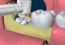 Demonstração extração dente do siso