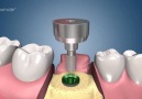 Dental Implant Procedure!