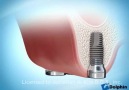 dental implants with Sinus Lift