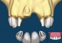Dental Implant Vs Bridge