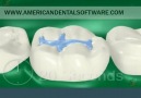 Dental Patient Education Tooth Fillings in 3D
