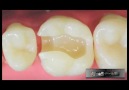 Dentes posteriores - Professores Charles Melo, Danilo Caldas e...