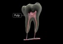 Diş Apsesi -3D Anatomi Video
