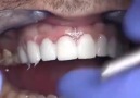 Diş kaplama nasıl yapılıyor