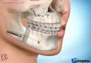 Diş telinin Tedavisi