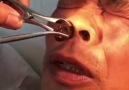 Doctor yanks out huge live leech from man&nostril!