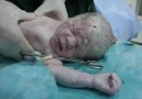 Doktorlar bombalama sırasında Suriyede doğan bir bebeği hayatta tutuyor.