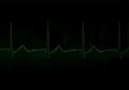EKG ÖRNEKLERİ