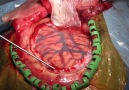 Epilepsy Surgery