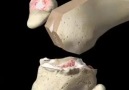 Excellent video of how it is done a replacement knee..!!