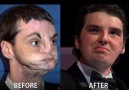 Face transplants are getting better and better!