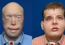 Firefighter recovering from historic face transplant surgery