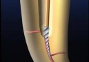 Fractured Instrument removal with Ultrasound - Animation