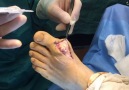 Gout crystals removal surgery