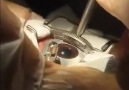 Göz ameliyatı nasıl yapılıyor
