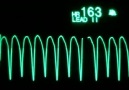 Günaydın...Güne Bir Kalp Krizi&- EKG Öğrenme ve Okuma - ECG Learning