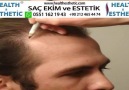 hair transplant healthestheticSaç ekim uygulamaları