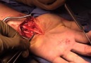 Hand Nerve Repairing Surgery