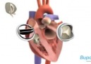Heart Valve Replacement Surgery !